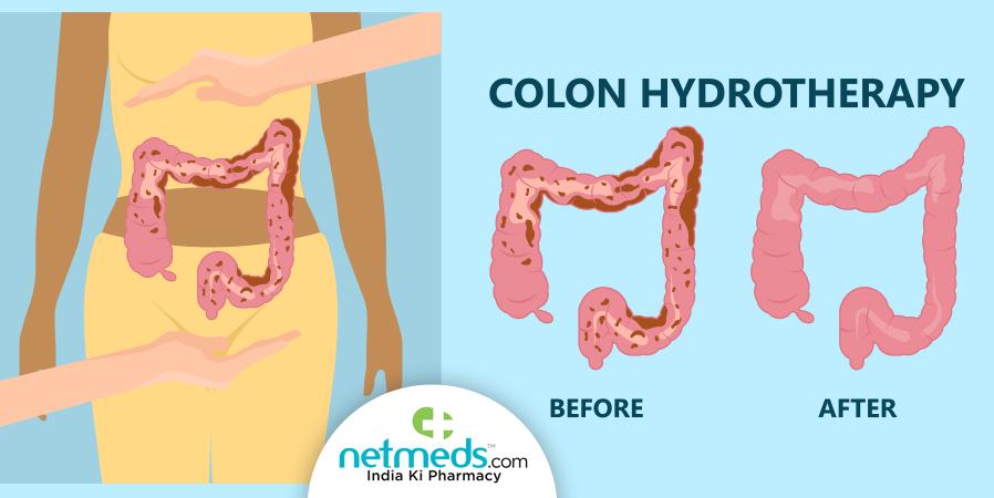 Important Considerations for a⁤ Successful Colon Cleansing ‍Experience